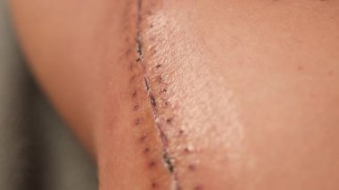 Side view of a thigh with a scar. High quality 4k footage