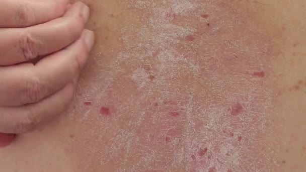 Psoriasis Een Persoon Krabt Psoriatische Huiduitslag Zijn Rug Met Zijn — Stockvideo