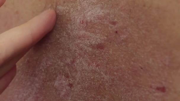 乾癬性の発疹のプラークと傷の上に手を動かす男の閉鎖 — ストック動画