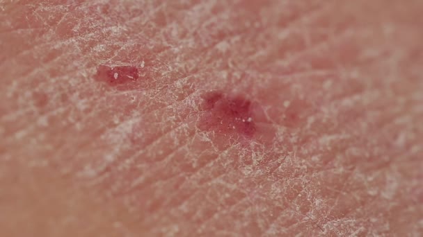 Psoriasis Primer Plano Piel Espalda Una Persona Afectada Por Las — Vídeo de stock