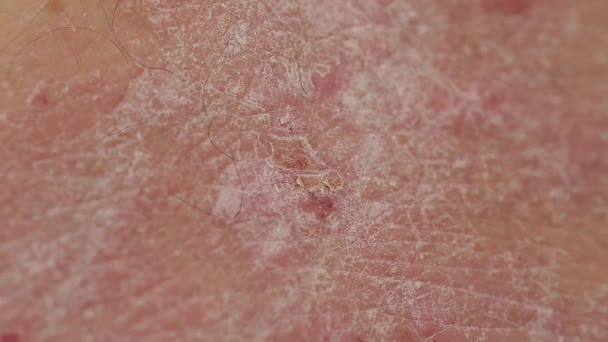 乾癬の傷の影響を受けた人の背中の皮膚の近くにプラークの発疹 — ストック動画