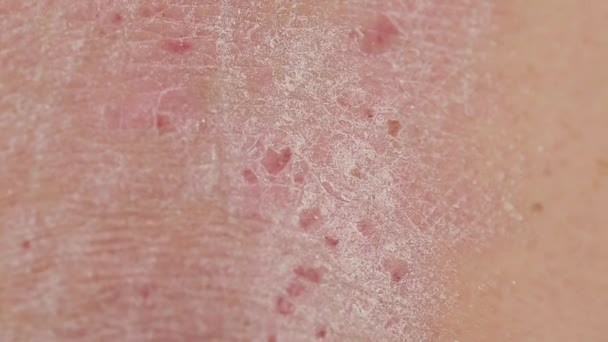 Psoriasis Zona Piel Espalda Una Persona Afectada Por Psoriasis Heridas — Vídeos de Stock