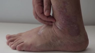 Sedef hastalığı. Bir adam sedef hastalığından etkilenen ayağı tarar.
