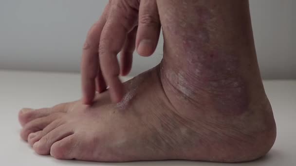 Psoriasis. Seorang pria menyisir daerah kaki dipengaruhi oleh plakat psoriatik — Stok Video