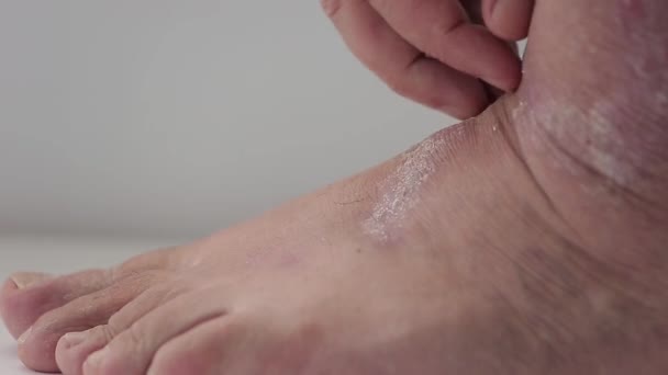 Psoriasis. Een man kamt het gebied van de voet dat door psoriatische plaques van dichtbij wordt getroffen — Stockvideo