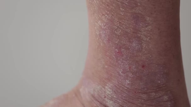 Psoriasi. Un uomo pettina l'area della gamba inferiore colpita da placche psoriasiche, eruzioni cutanee e ferite. Da vicino. . — Video Stock