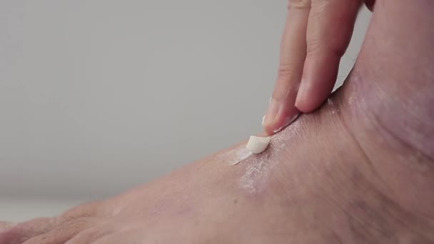 Psoriasis. Mannen smører salven inn i den berørte delen av foten med psoriasisplakk, utslett og sår. Lukk. – stockvideo