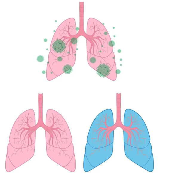 Pulmones Limpios Listos Para Medicinas Coronavirus Respiratorio — Archivo Imágenes Vectoriales