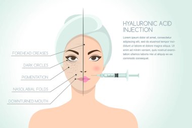 Kadının hiyalüronik asit yüz enjeksiyonunun önce ve sonra çizimi. Vektör bilgi grafikleri tasarım şablonu. Güzellik, kozmetoloji, yaşlanma karşıtı konsept.