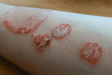 Erkeklerin kolunda sedef hastalığı var.