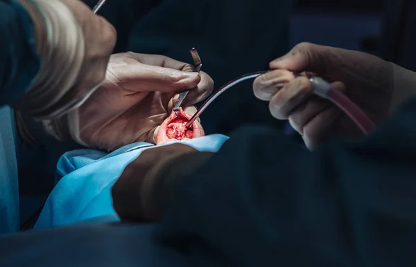 Cosmetic surgery on nose. The surgeon cuts the flesh