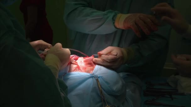 Chirurg i jego asystent, wykonywania operacji plastycznej nosa — Wideo stockowe