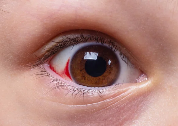 Οφθαλμικές Παθήσεις Κόκκινα Μάτια — Φωτογραφία Αρχείου