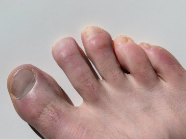 Distal falanjın kırılmasından sonra fibrokıkırdak nasırı olan ayak ve orta ayak yakınlaşması.