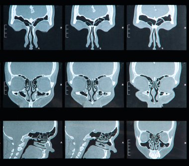 Burun ile insan sinüs MRI tarama