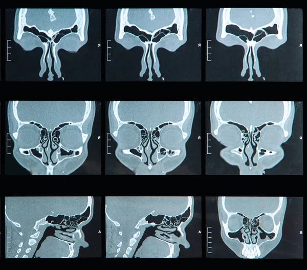 鼻腔とヒトの洞の Mri スキャン — ストック写真