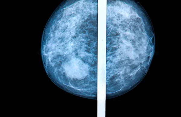 Mamografía Escaneo Mama Imagen Rayos Imagen De Stock