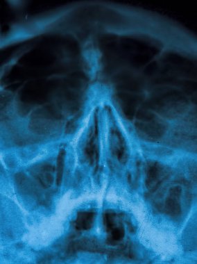 X-ışını-sinüsler ve nazal kemik