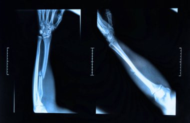 x-ray görüntü göstermek radius kemik kırığı