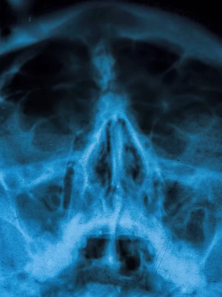 Radiografía Senos Paranasales Huesos Nasales Fotos De Stock