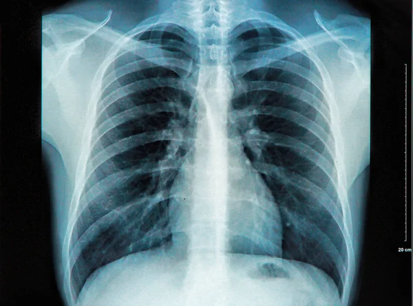 Röntgenbild Der Menschlichen Brust — Stockfoto