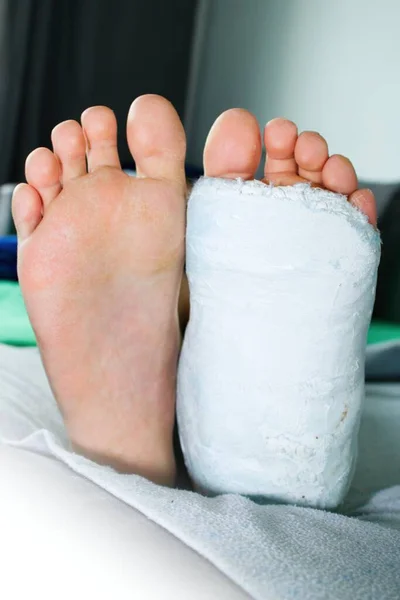 Деталь Ног Левая Нога Нога Белой Штукатурке Мальчика Сломана Лодыжка — стоковое фото