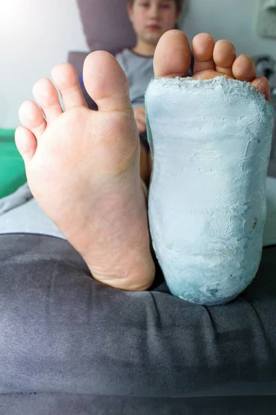 Detail feet - left leg or foot in white plaster.Broken leg in plaster. The boy has a broken ankle.