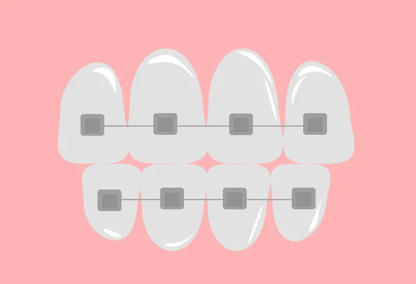 Illustrazione Vettoriale Apparecchi Ortodontici Strutture Fisse Ortodontiche Complesse Dispositivi Correggere — Vettoriale Stock
