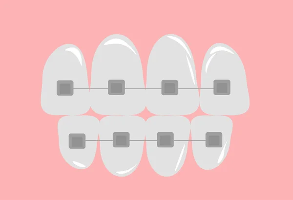 Vector Illustratie Orthodontische Beugels Complexe Orthodontische Vaste Structuren Apparaten Voor — Stockvector