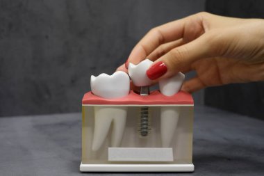 Gri arka planda implantı olan bir ekmek tahtası modeli.