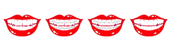 Διάνυσμα σύνολο κινουμένων σχεδίων χαμογελώντας στόματα με στάδια ευθυγράμμισης των δοντιών χρησιμοποιώντας ορθοδοντική μεταλλικά στηρίγματα σε λευκό φόντο — Διανυσματικό Αρχείο