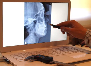 Dişçi bilgisayarda panoramik diş röntgeni çalışıyor.