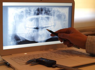 Dişçi dizüstü bilgisayarda panoramik diş röntgeni üzerinde çalışıyor.   