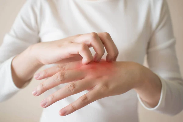 Jonge Vrouw Krabt Jeuk Aan Haar Handen Roodheid Uitslag Oorzaak — Stockfoto