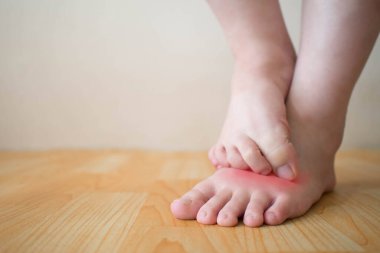 Genç bir kadın kızarıklıkla ayaklarını kaşıyordu. Kaşınan derinin nedeni atlet ayağı (mantar enfeksiyonu), dermatit (egzama), sedef hastalığı veya böcek ısırıkları. Sağlık hizmetleri. Boşluğu kopyala.