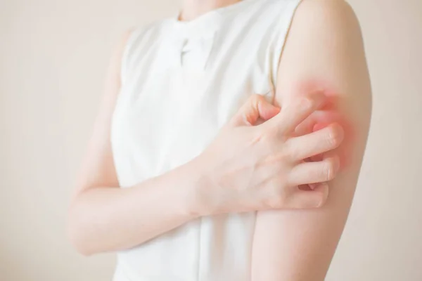 Beyaz arka planda kaşınmaktan kolları kaşınan genç bir kadın. Kaşınan derinin nedeni böcek ısırıkları, dermatit, gıda / ilaç alerjisi veya kuru cilt. Sağlık hizmeti konsepti. Kapat..