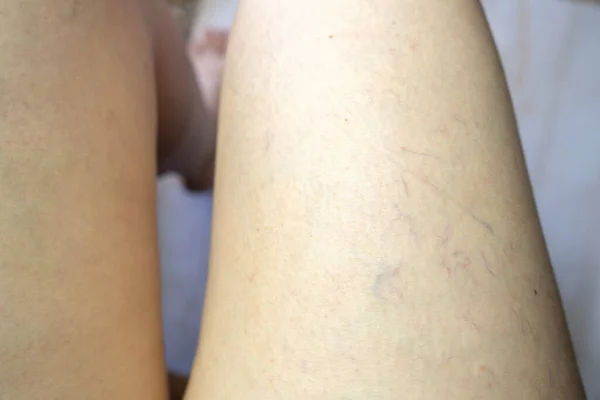 varicose veins on the skin. concept of varicose disease and cosmetology. legs with vascular stars. spider veins on leg