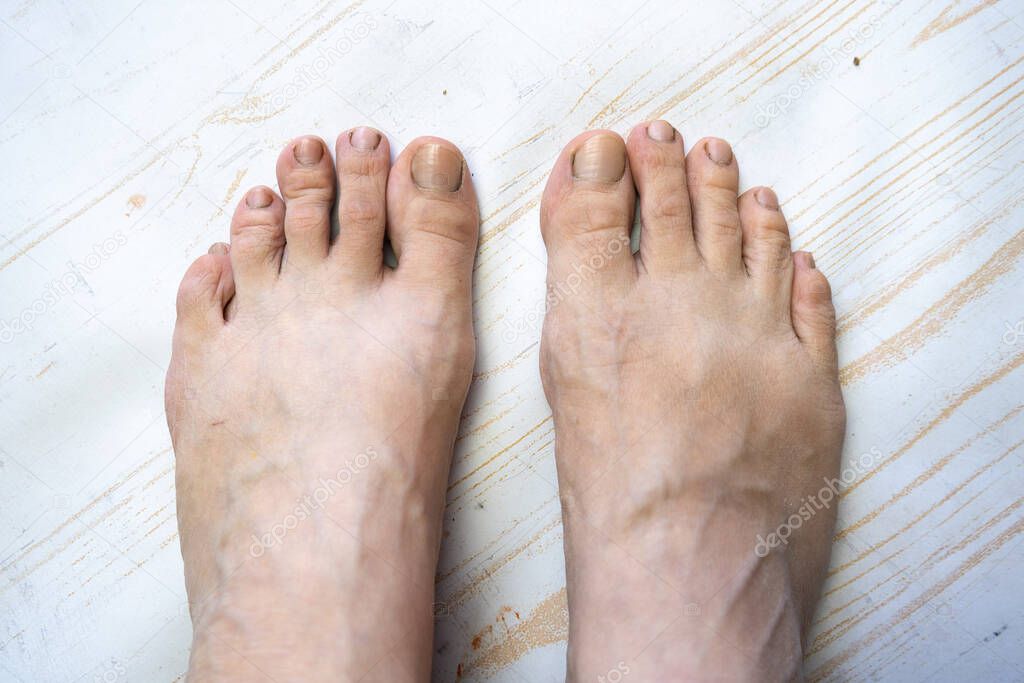 bare feet of caucasian female in bad condition, dry unhealthy toes with dirty damaged nails