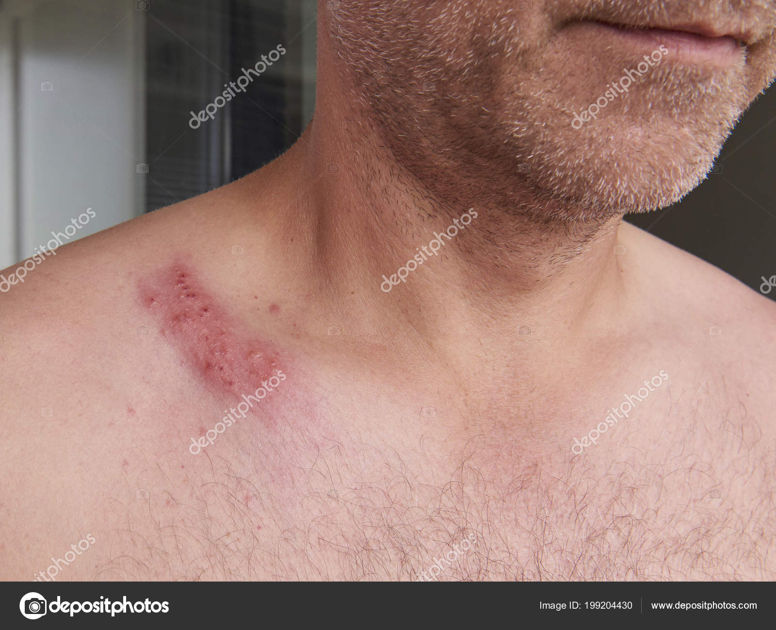 Imagenes D Herpes En La Piel Closeup Brote Herpes Piel Humana