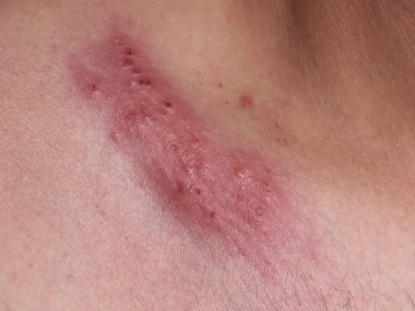 Closeup Outbreak Herpes Human Skin — Stock Photo, Image