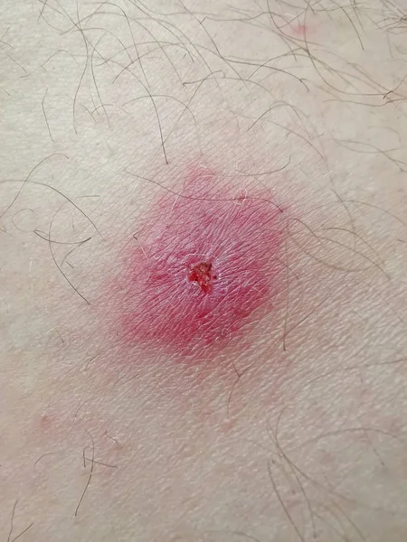 Closeup of a bug bite — Stock Photo, Image