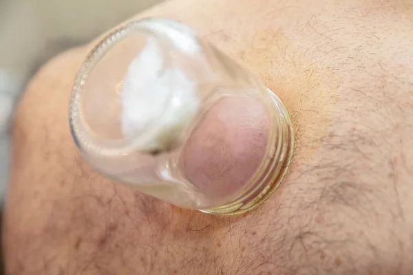 Läkande Blodsutgjutelse Hijama Eller Flebotomi Hajam Master Utför Cupping Terapi — Stockfoto