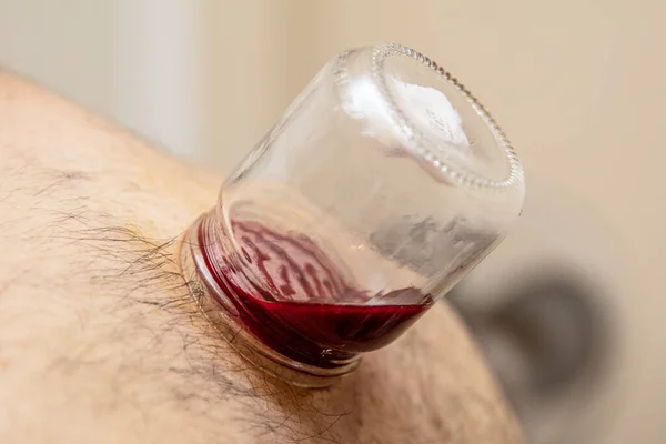 Läkande Blodsutgjutelse Hijama Eller Flebotomi Hajam Master Utför Cupping Terapi — Stockfoto