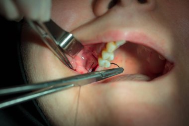 Dişçi diş telleriyle dişleri inceliyor.