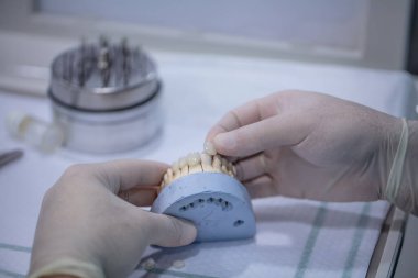 Alçıtaşı Stomatolojik insan çenesi. Alçı modelinde seramik metal kaplama