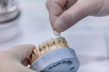Alçıtaşı Stomatolojik insan çenesi. Alçı modelinde seramik metal kaplama