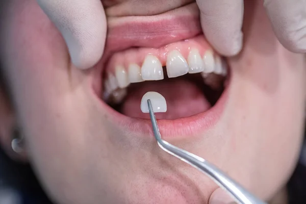 Dente Prótese Cerâmica Substituindo Dentes Naturais Ausentes — Fotografia de Stock