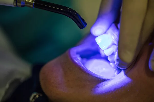Dentista Masculino Está Enchendo Dente Com Paciente Uma Menina Bonita — Fotografia de Stock