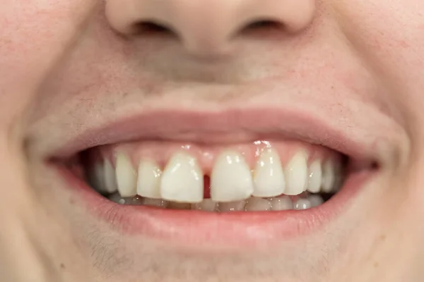 Ceramiczny Ząb Protezy Zastępujący Brakujące Naturalne Zęby — Zdjęcie stockowe