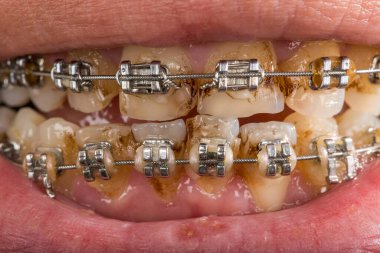 closeup of a mouth with braces  